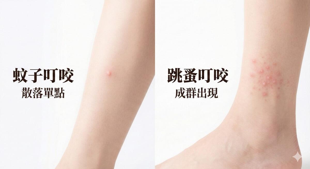 蚊子與跳蚤叮咬的差別示意圖